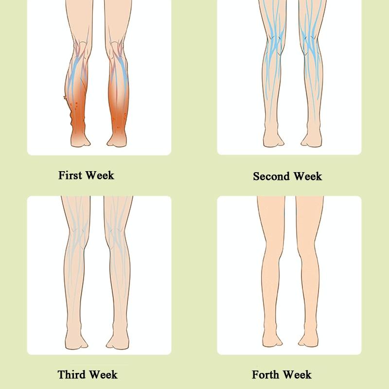 Calf Air Wave Massager For Varicose Vein Relief Household Physiotherapy Device