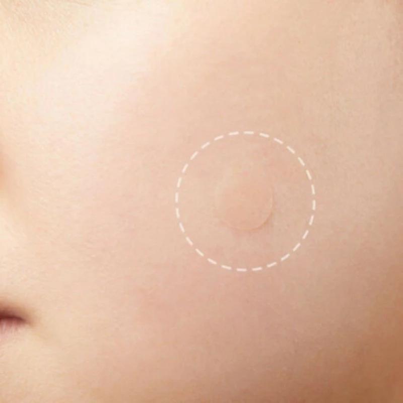 3-Piece Acne Treatment Set For Scars And Pimples-1915197382761517057
