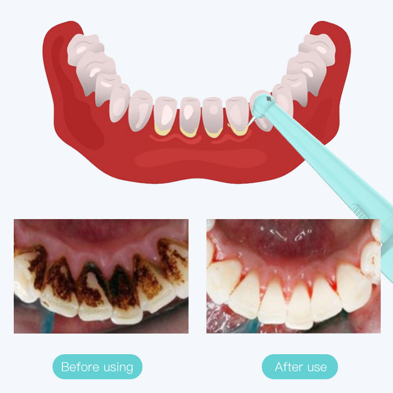 Intelligent High-Frequency Vibration Dental Calculus & Stain Remover(black)